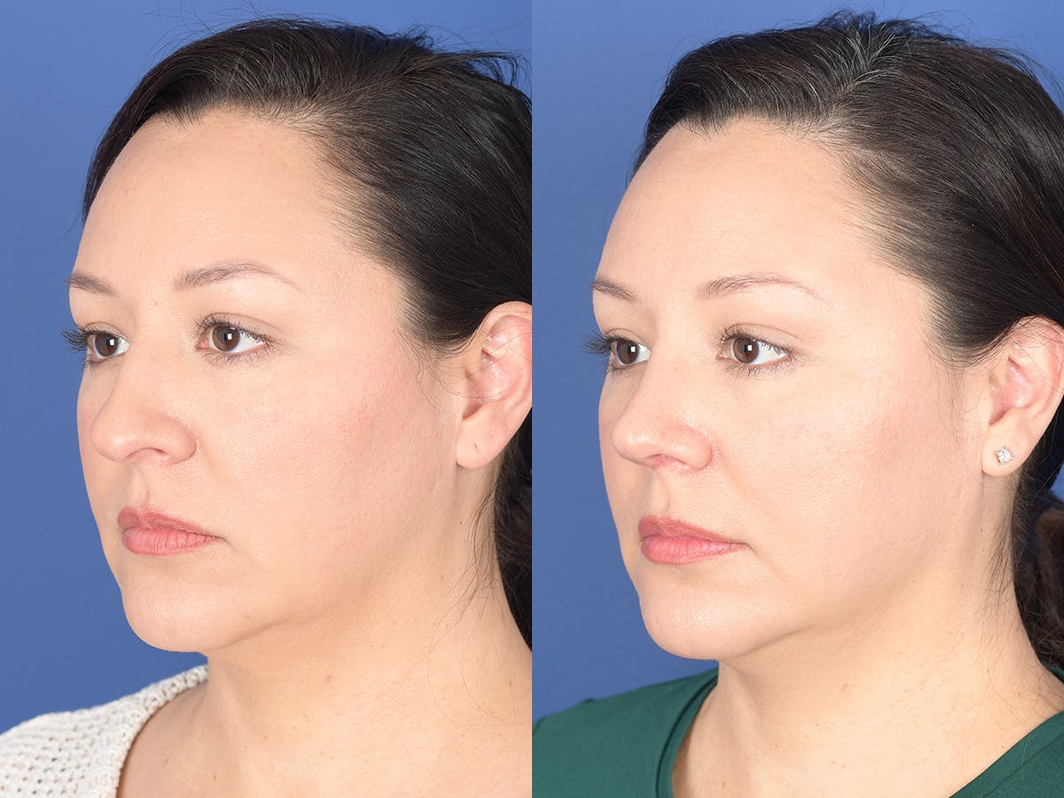 Rhinoplasty Before & After Gallery - Patient 391234 - Image 3