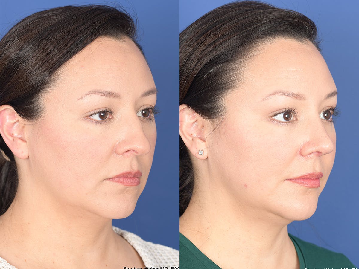 Rhinoplasty Before & After Gallery - Patient 391234 - Image 4