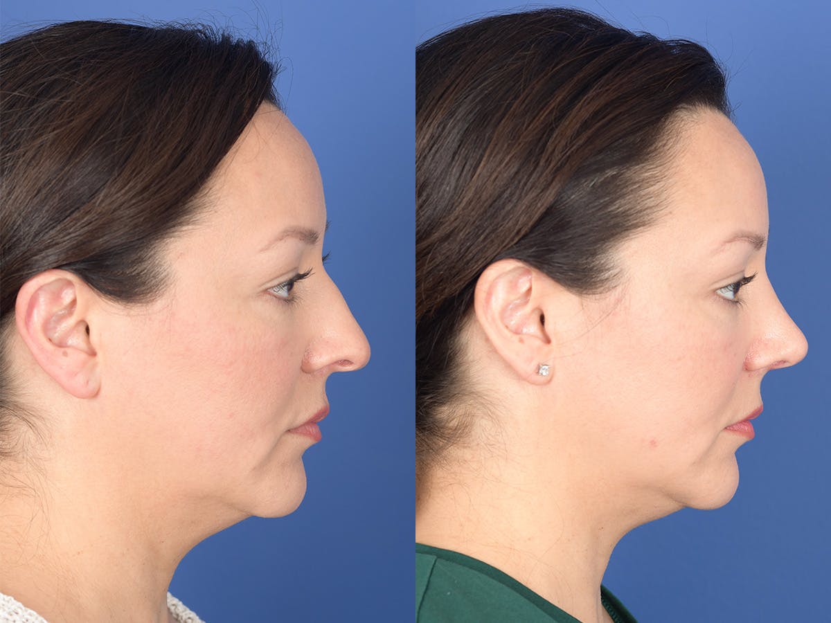 Rhinoplasty Before & After Gallery - Patient 391234 - Image 5