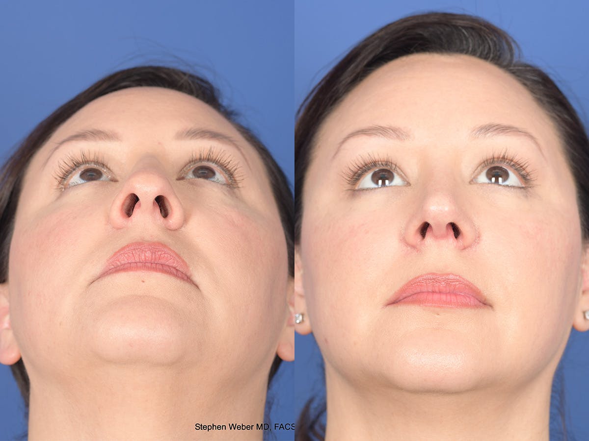 Rhinoplasty Before & After Gallery - Patient 391234 - Image 6