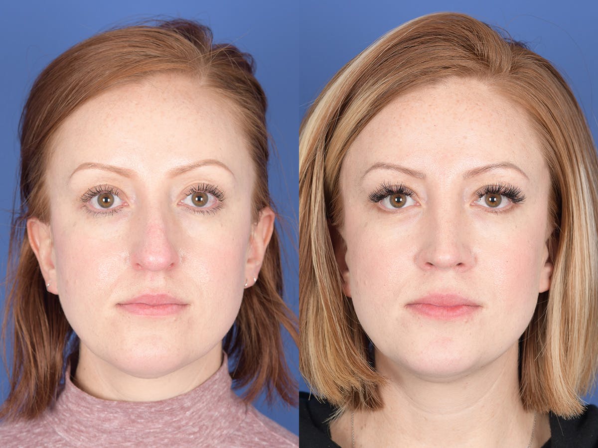 Rhinoplasty Before & After Gallery - Patient 407145 - Image 1