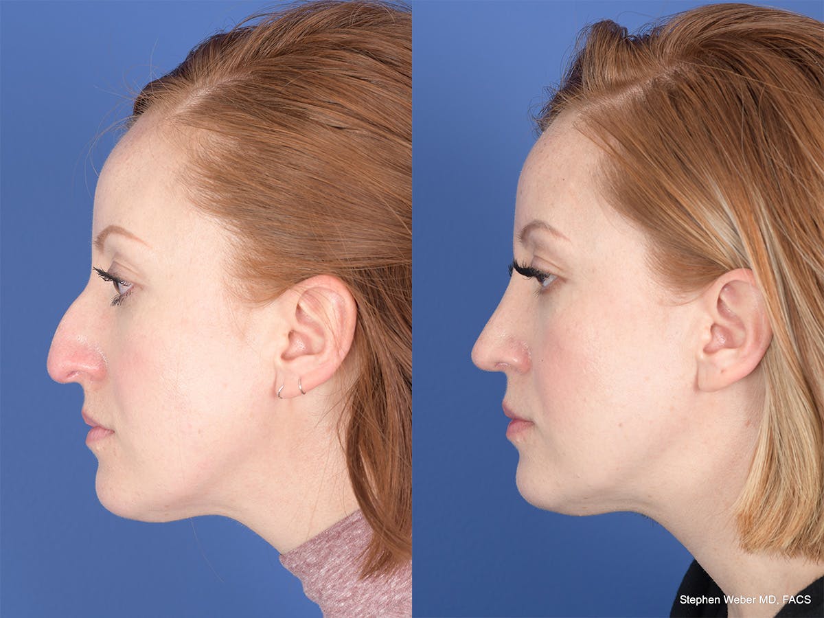 Rhinoplasty Before & After Gallery - Patient 407145 - Image 2