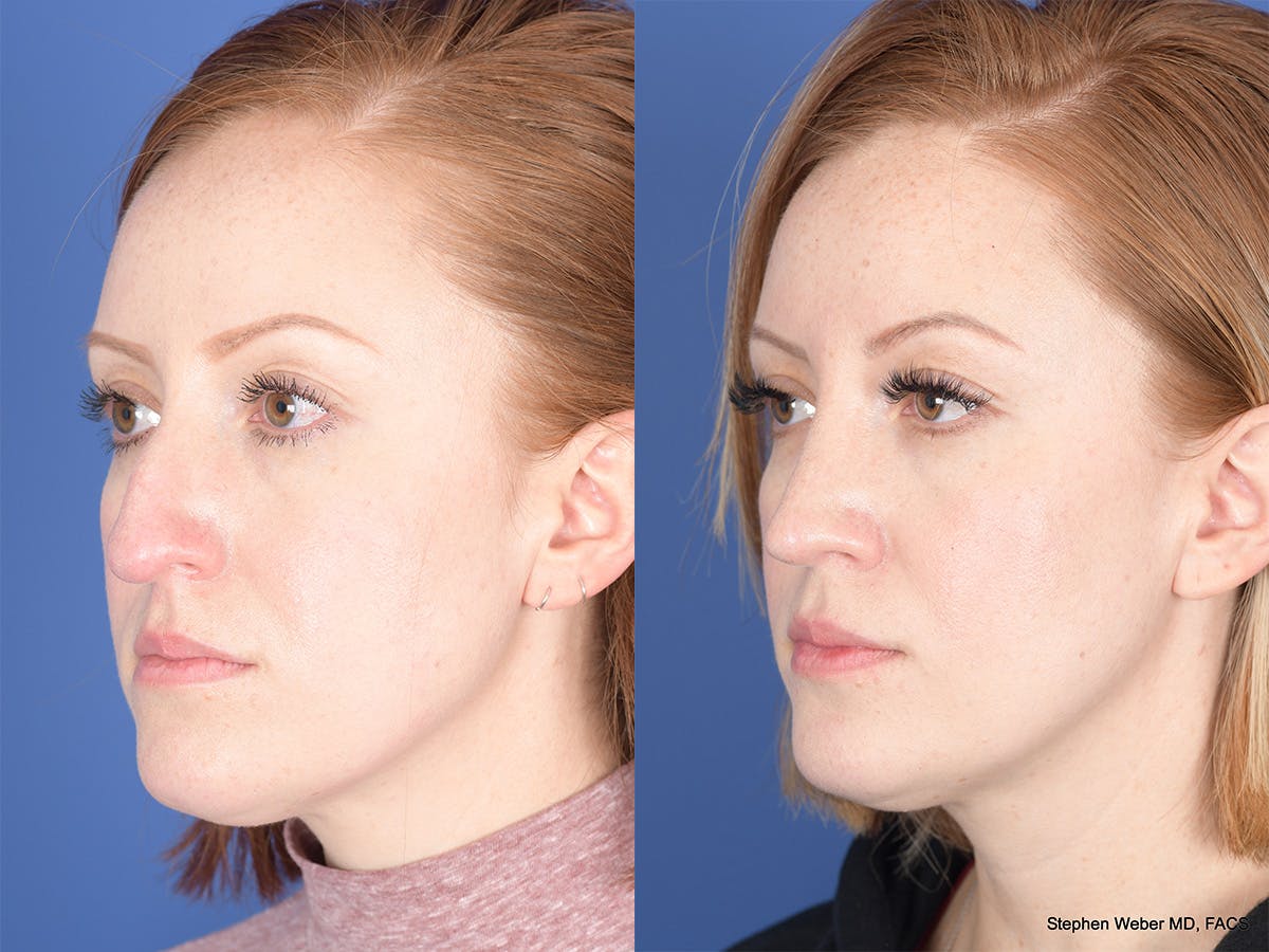Rhinoplasty Before & After Gallery - Patient 407145 - Image 3