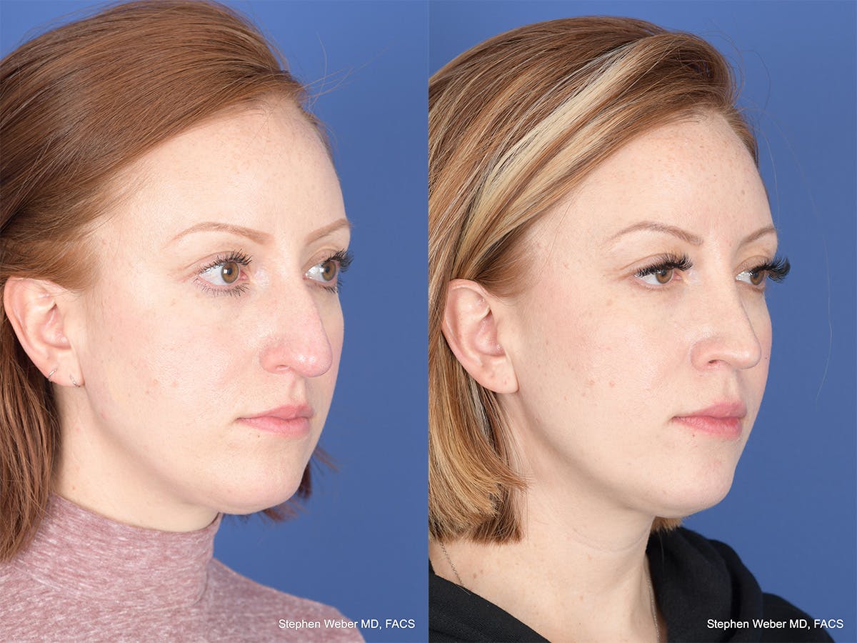 Rhinoplasty Before & After Gallery - Patient 407145 - Image 4
