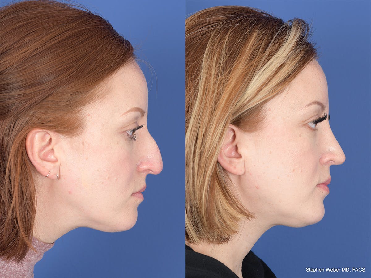 Rhinoplasty Before & After Gallery - Patient 407145 - Image 5