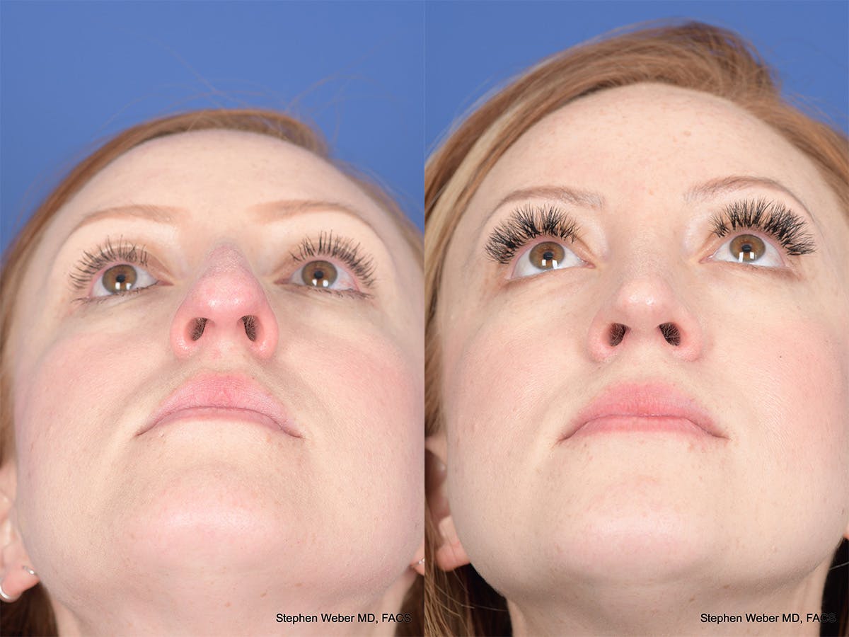 Rhinoplasty Before & After Gallery - Patient 407145 - Image 6
