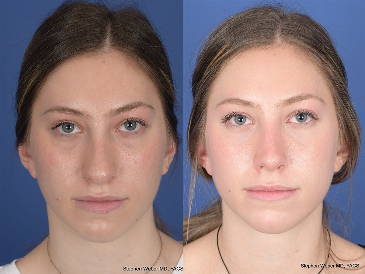 Rhinoplasty Before & After Gallery - Patient 111674 - Image 1
