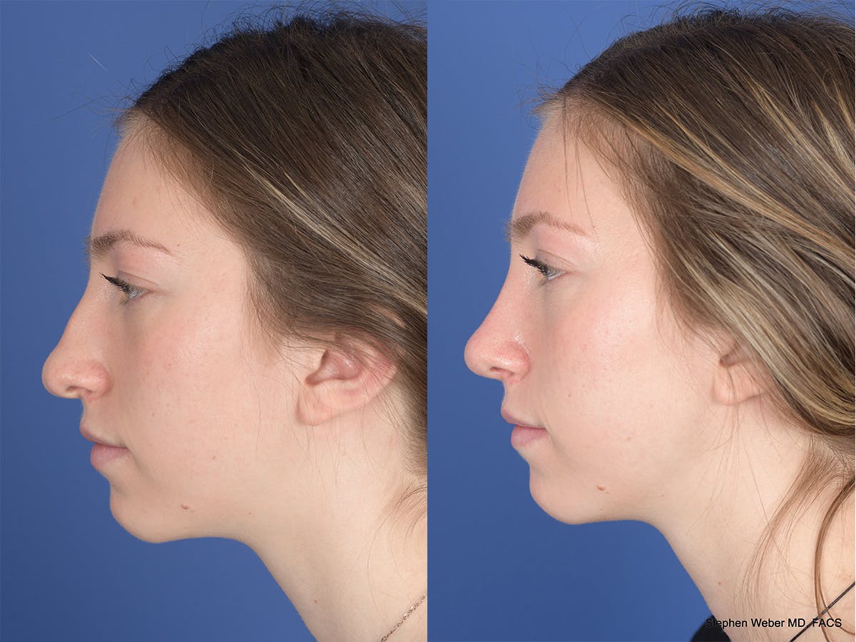 Rhinoplasty Before & After Gallery - Patient 111674 - Image 2