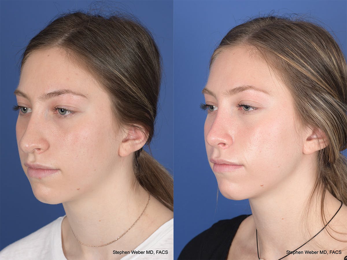 Rhinoplasty Before & After Gallery - Patient 111674 - Image 3