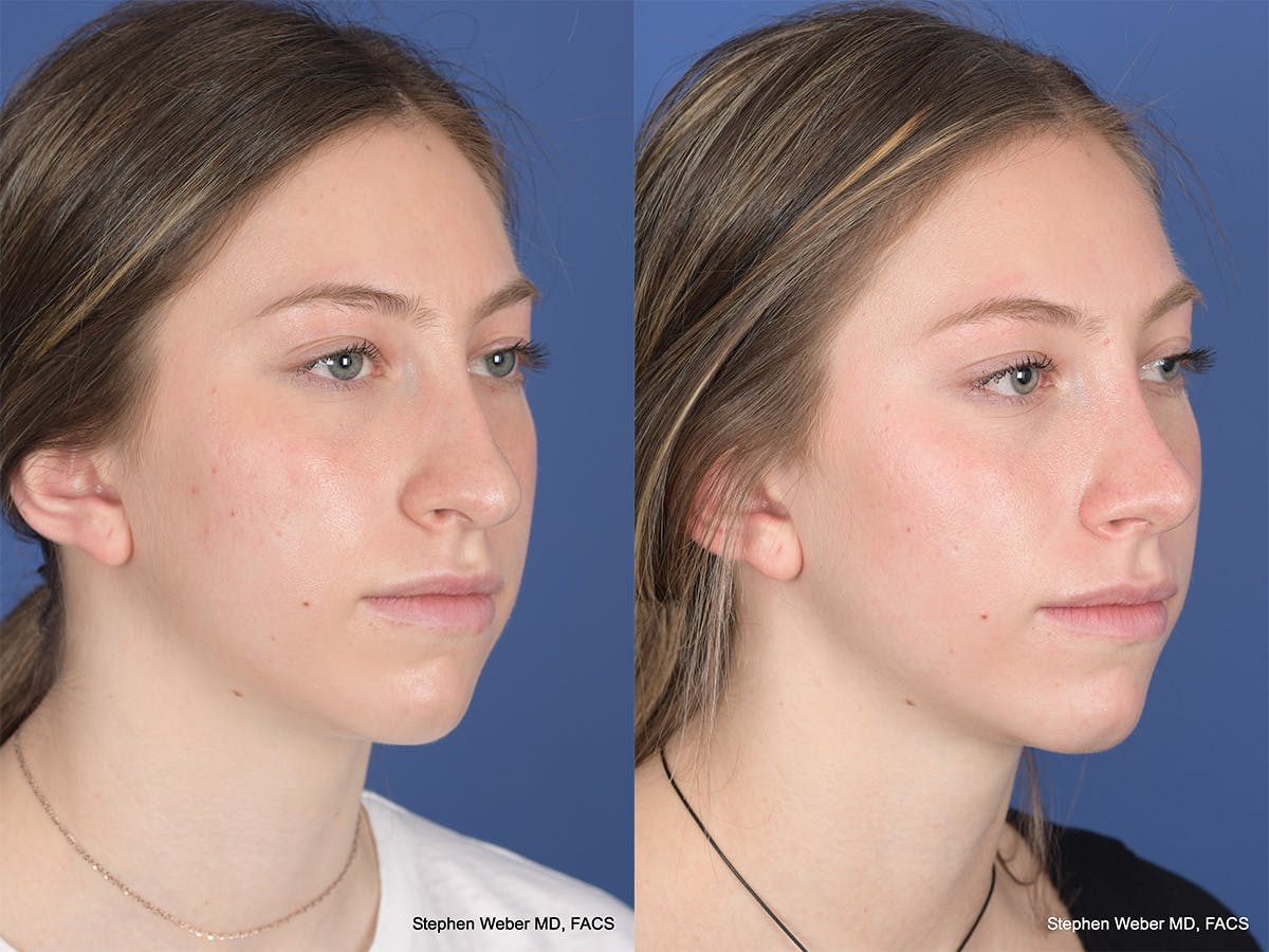 Rhinoplasty Before & After Gallery - Patient 111674 - Image 4