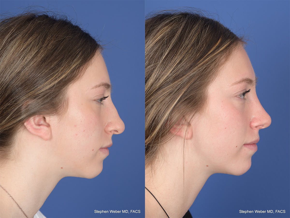Rhinoplasty Before & After Gallery - Patient 111674 - Image 5
