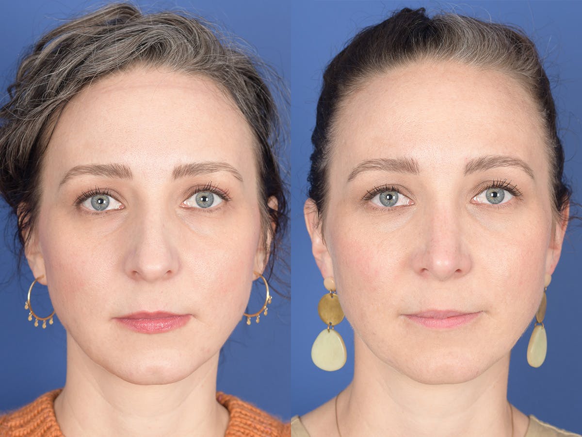 Rhinoplasty Before & After Gallery - Patient 337616 - Image 1