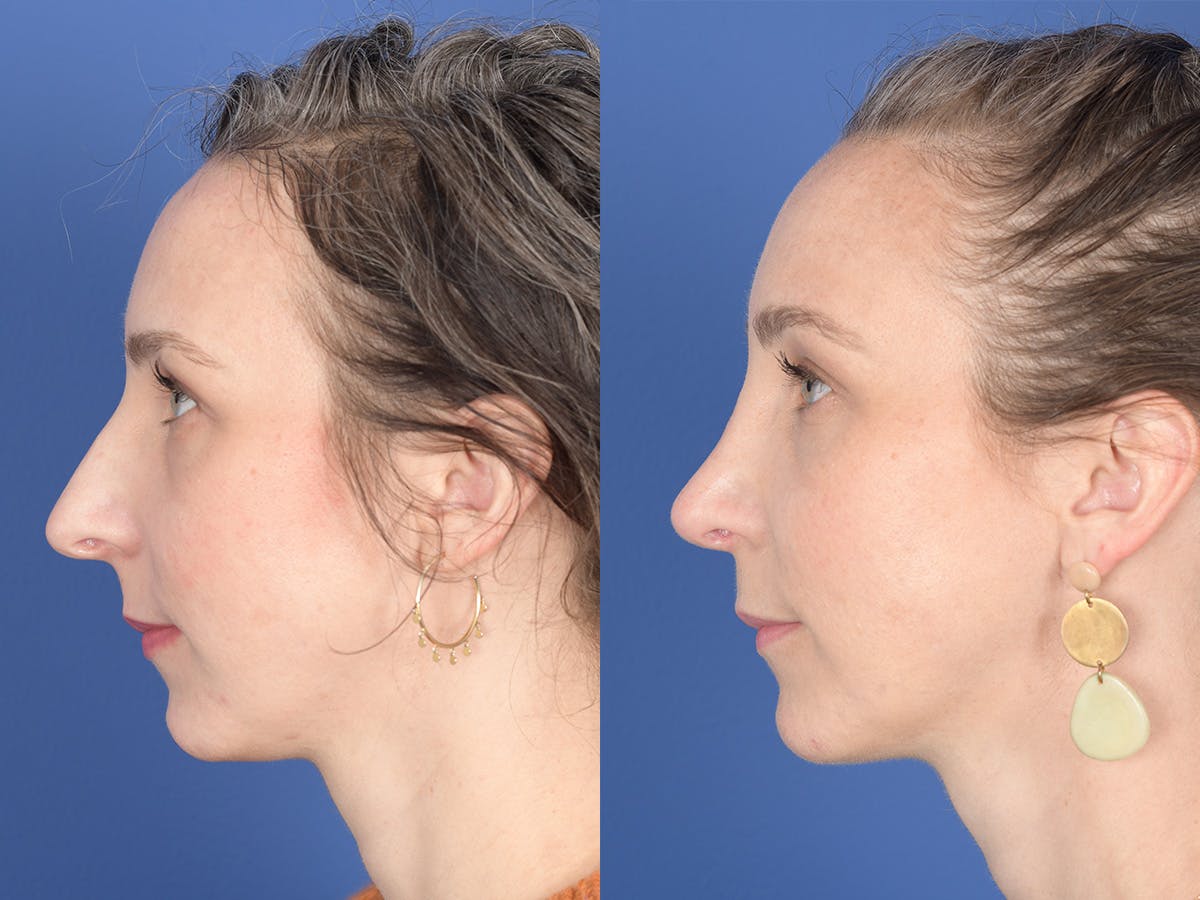 Rhinoplasty Before & After Gallery - Patient 337616 - Image 2