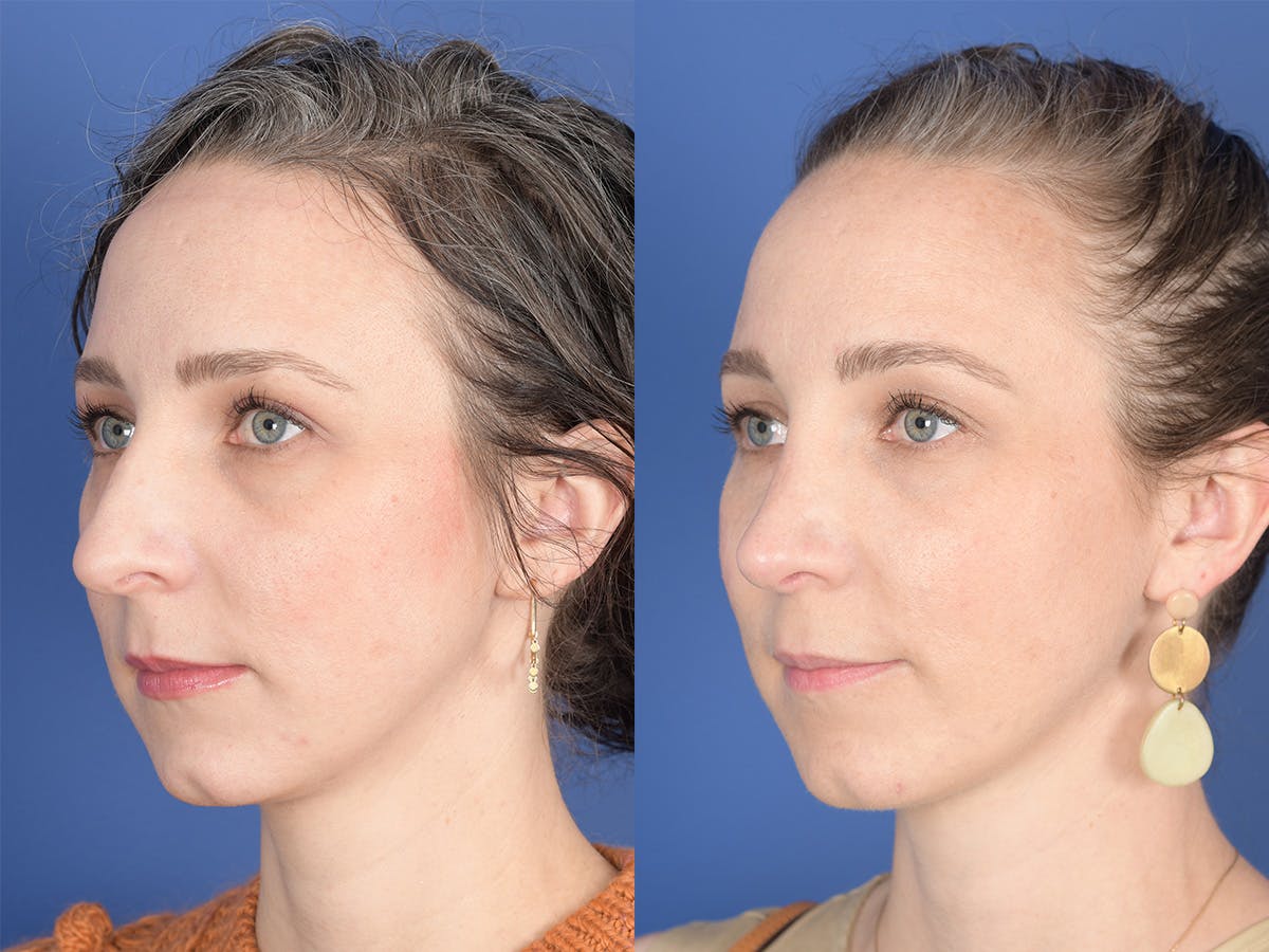 Rhinoplasty Before & After Gallery - Patient 337616 - Image 3