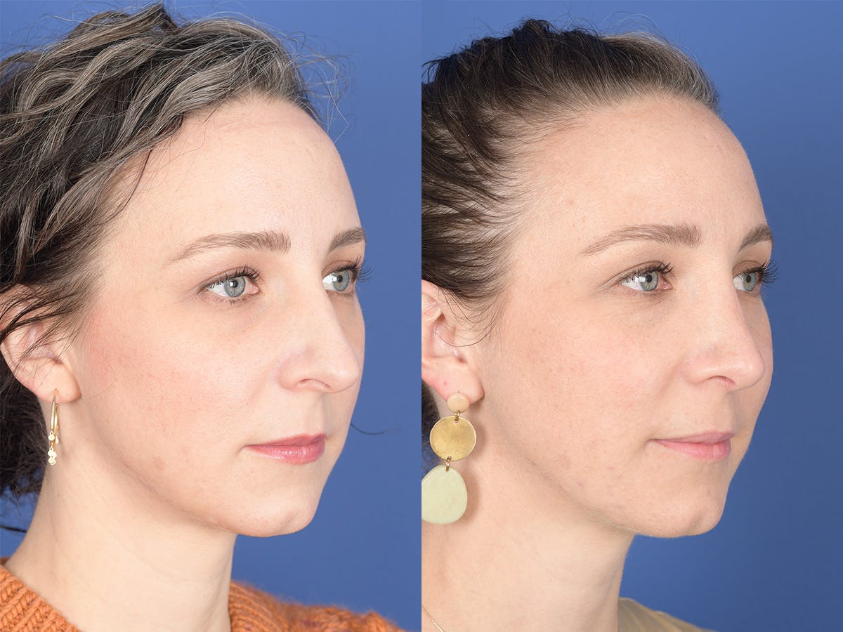 Rhinoplasty Before & After Gallery - Patient 337616 - Image 4