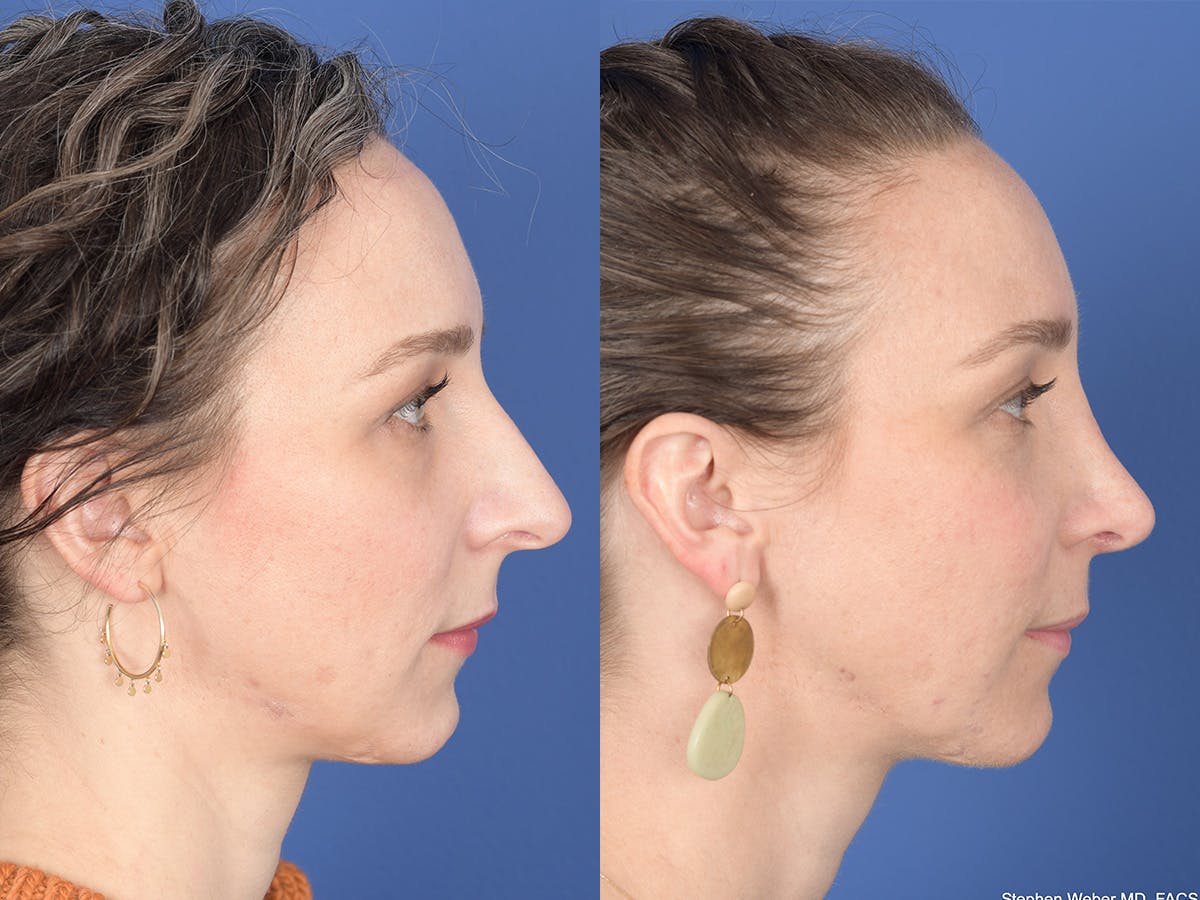 Rhinoplasty Before & After Gallery - Patient 337616 - Image 5