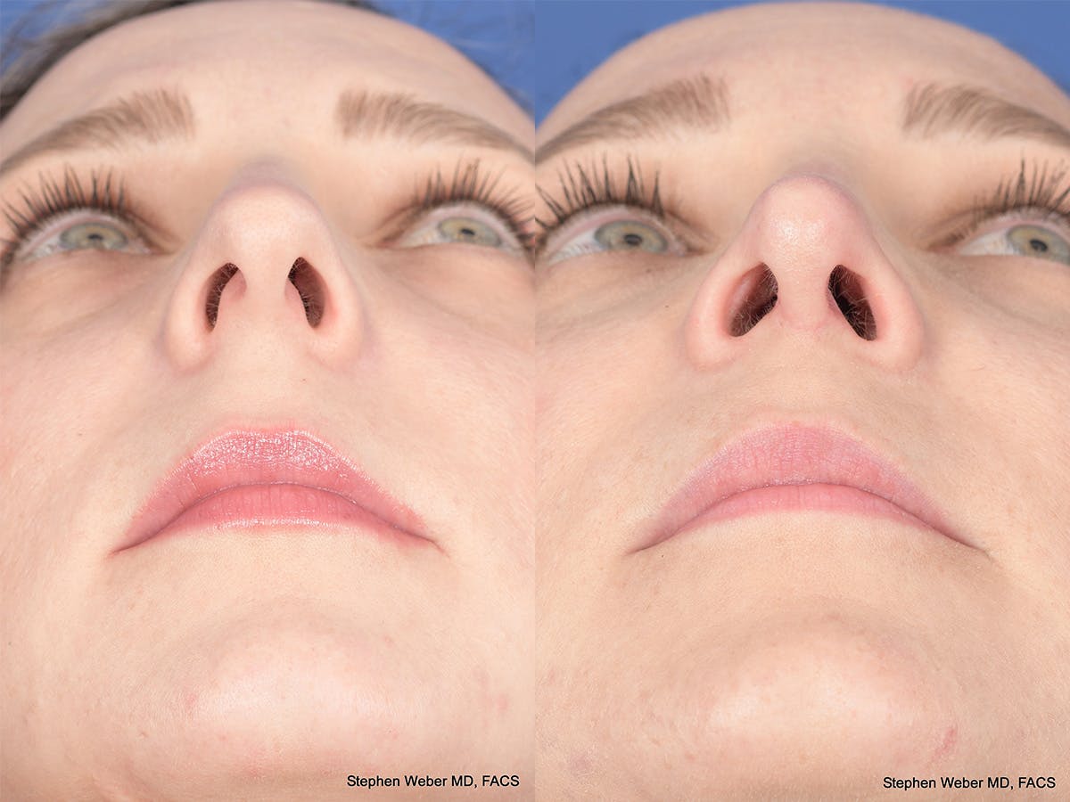 Rhinoplasty Before & After Gallery - Patient 337616 - Image 6