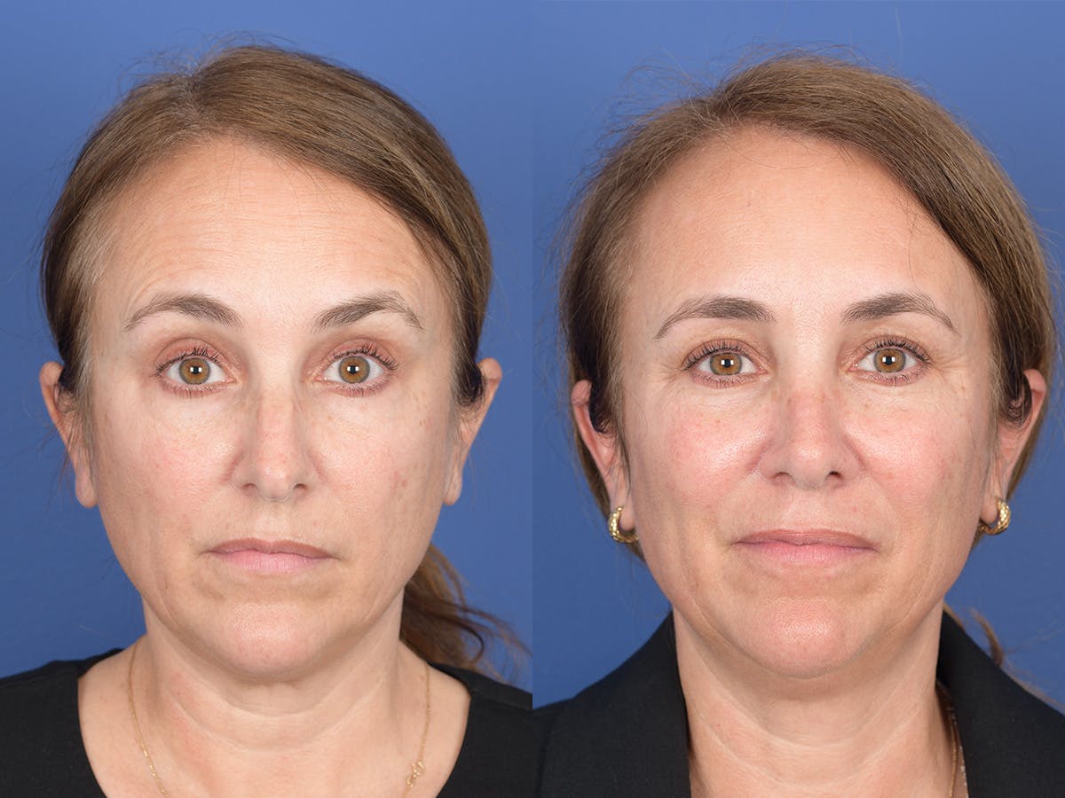 Rhinoplasty Before & After Gallery - Patient 343121 - Image 1