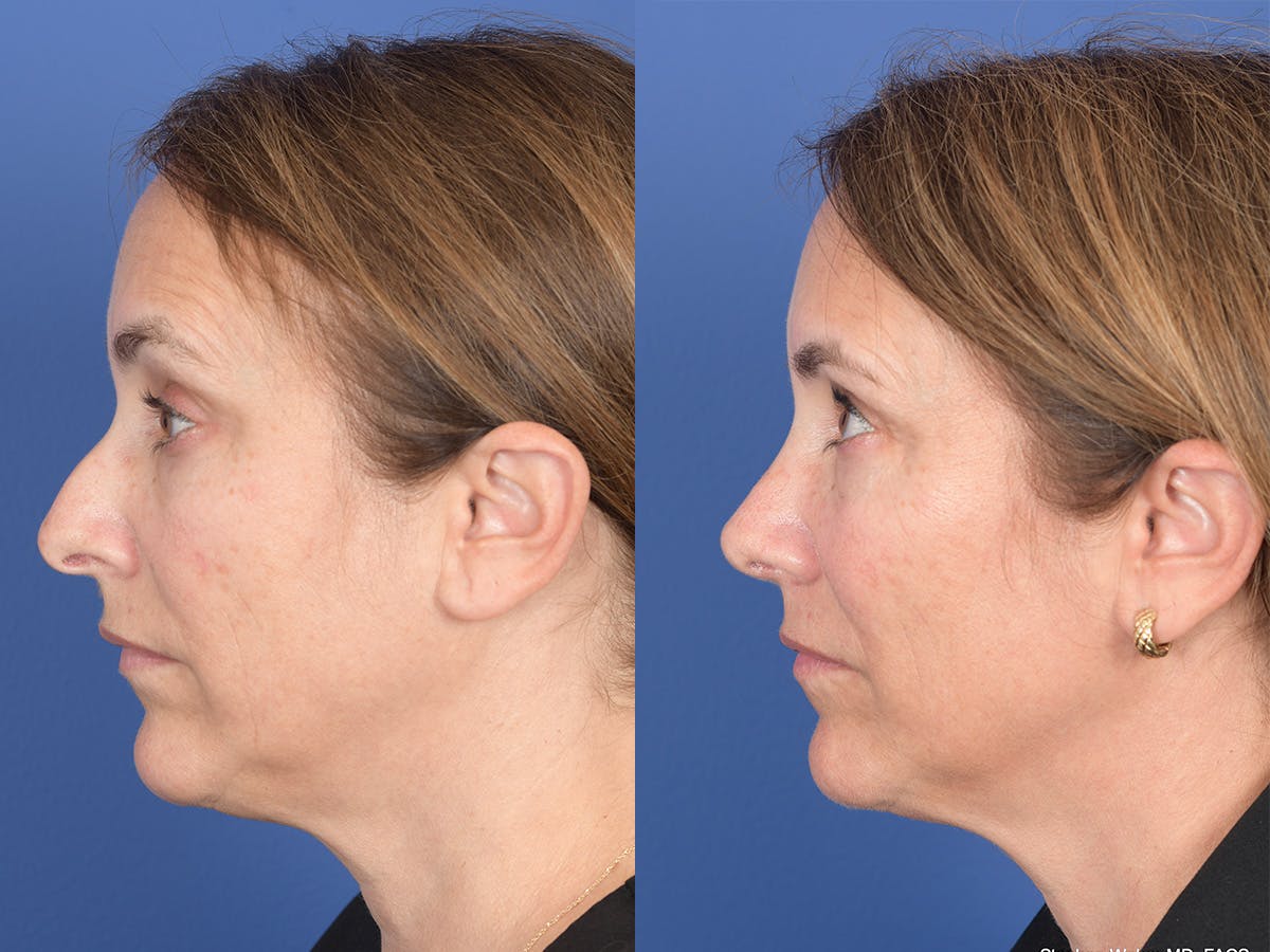 Rhinoplasty Before & After Gallery - Patient 343121 - Image 2