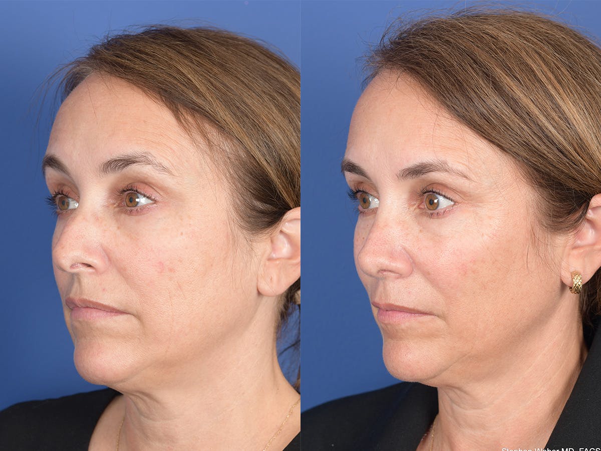 Rhinoplasty Before & After Gallery - Patient 343121 - Image 3