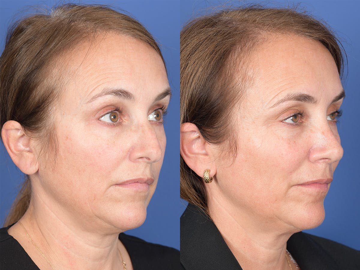Rhinoplasty Before & After Gallery - Patient 343121 - Image 4