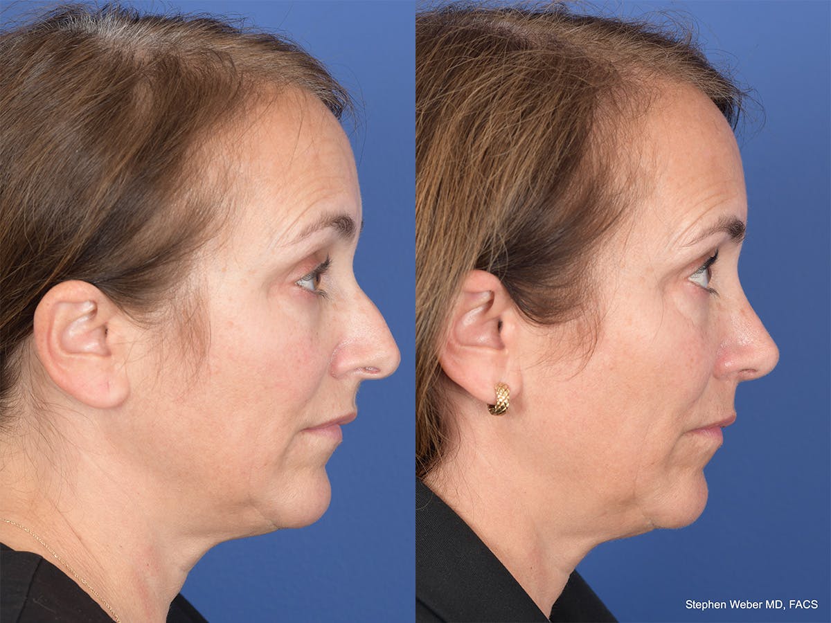 Rhinoplasty Before & After Gallery - Patient 343121 - Image 5