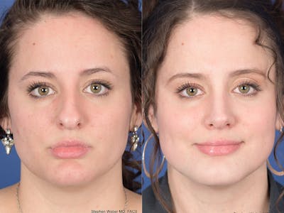 Rhinoplasty Before & After Gallery - Patient 179746 - Image 1