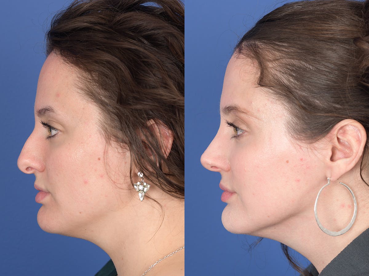Rhinoplasty Before & After Gallery - Patient 179746 - Image 2