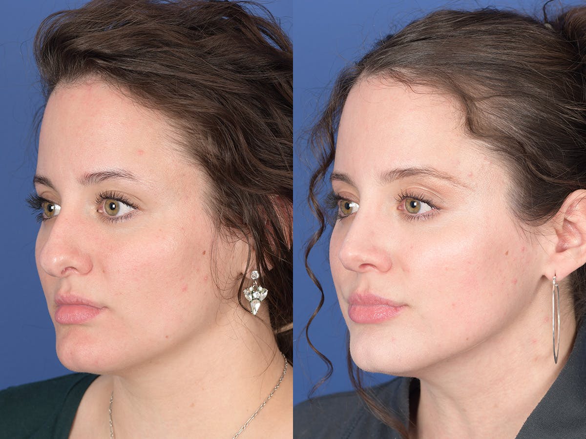 Rhinoplasty Before & After Gallery - Patient 179746 - Image 3