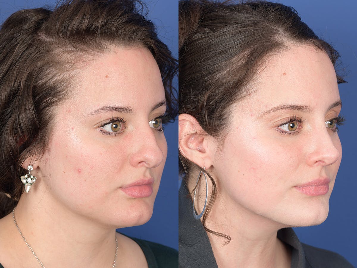 Rhinoplasty Before & After Gallery - Patient 179746 - Image 4