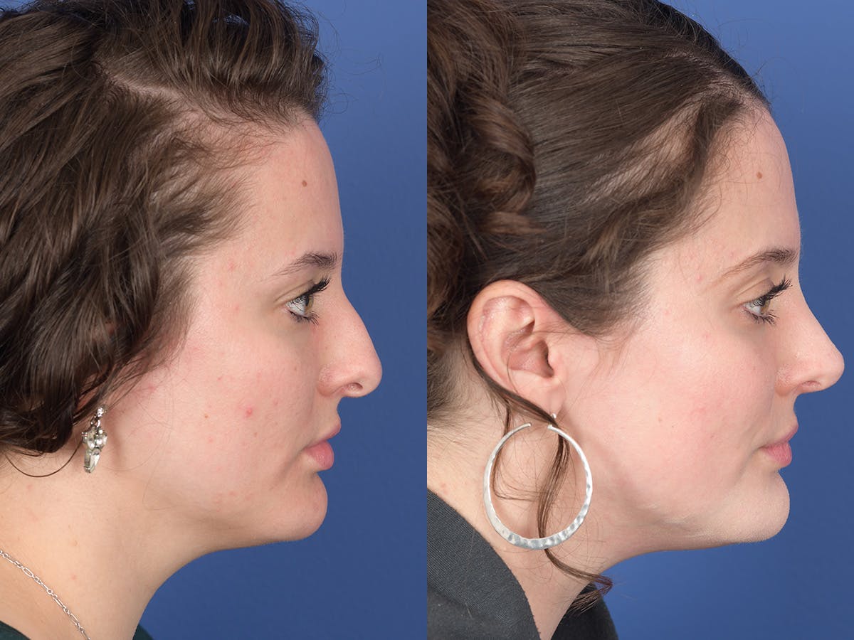 Rhinoplasty Before & After Gallery - Patient 179746 - Image 5