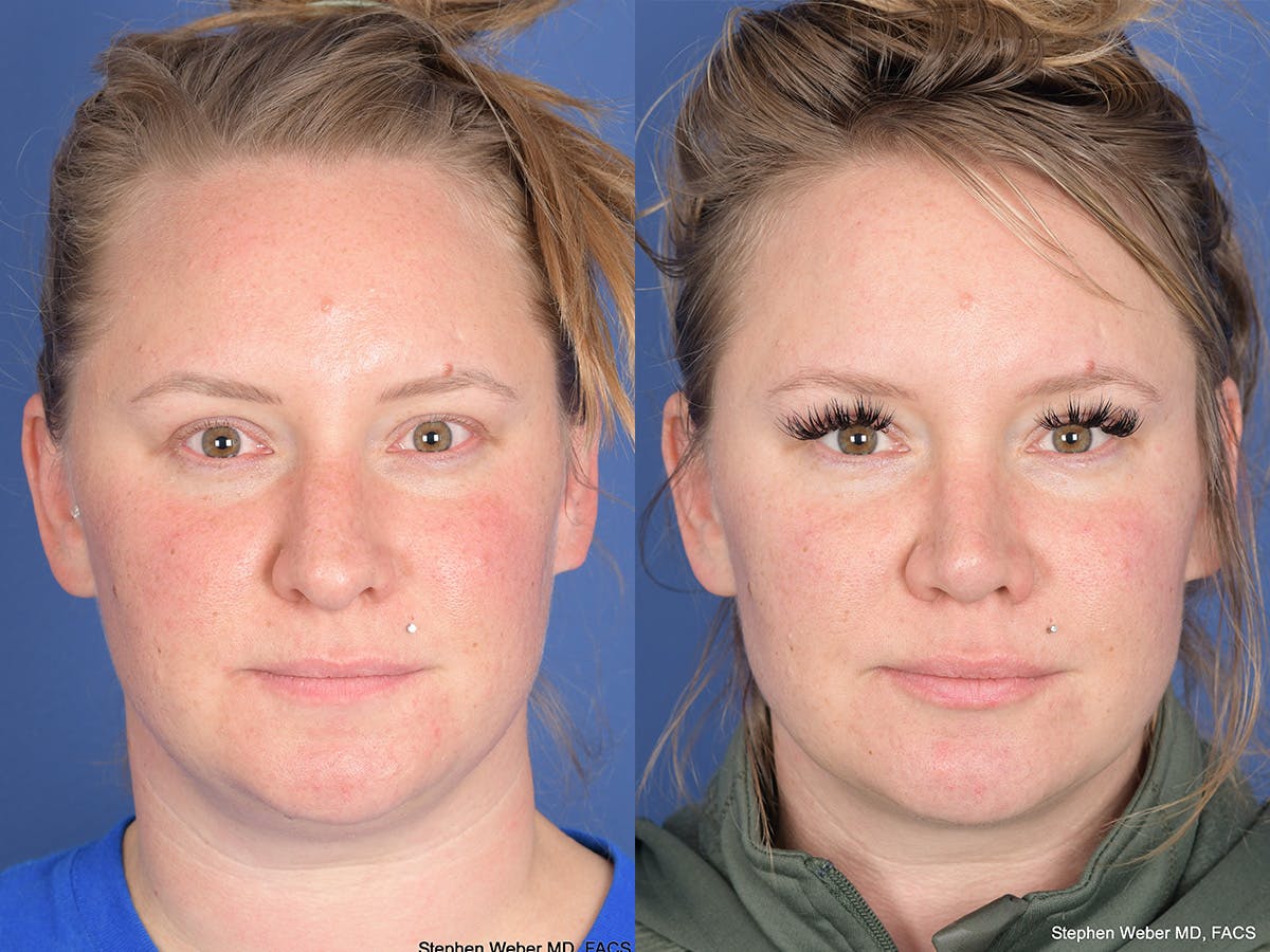 Rhinoplasty Before & After Gallery - Patient 305782 - Image 1