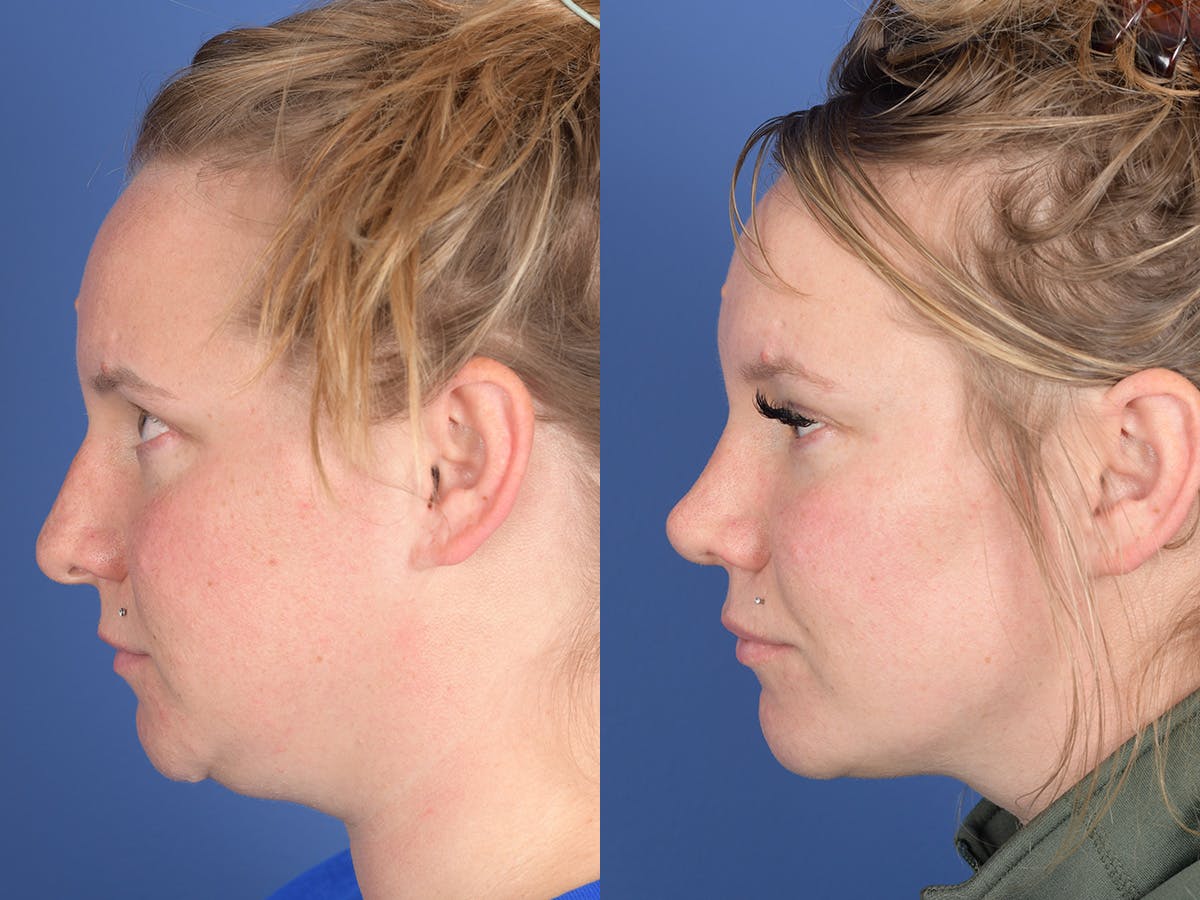 Rhinoplasty Before & After Gallery - Patient 305782 - Image 2