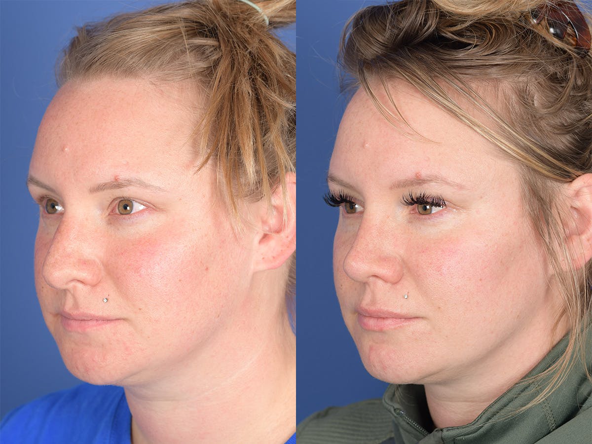 Rhinoplasty Before & After Gallery - Patient 305782 - Image 3