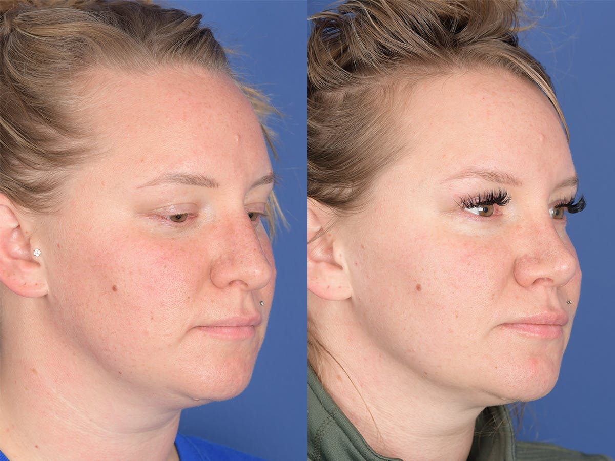 Rhinoplasty Before & After Gallery - Patient 305782 - Image 4