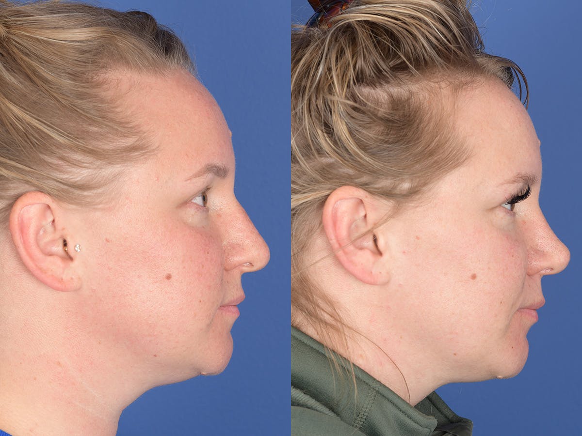 Rhinoplasty Before & After Gallery - Patient 305782 - Image 5