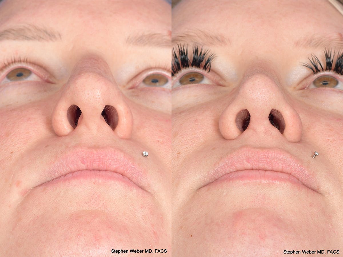 Rhinoplasty Before & After Gallery - Patient 305782 - Image 6