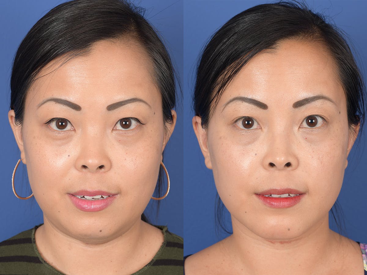 Rhinoplasty Before & After Gallery - Patient 149074 - Image 1