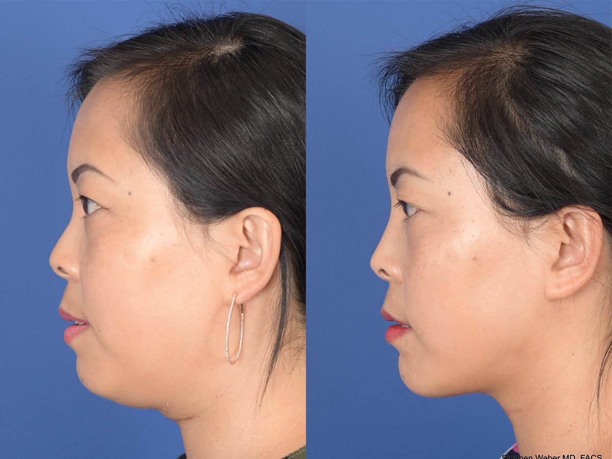 Rhinoplasty Before & After Gallery - Patient 149074 - Image 2