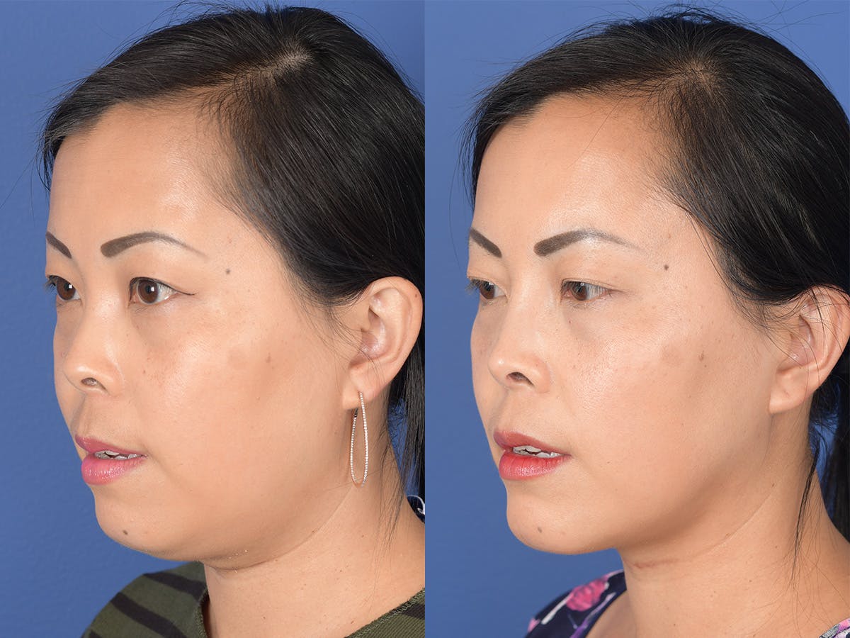Rhinoplasty Before & After Gallery - Patient 149074 - Image 3