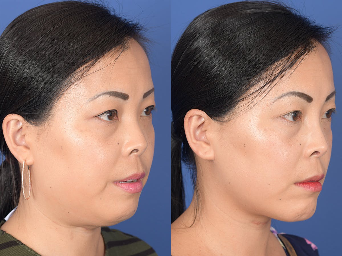 Rhinoplasty Before & After Gallery - Patient 149074 - Image 4