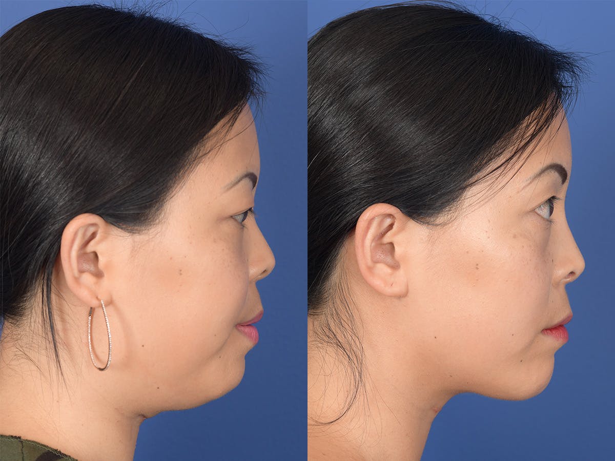 Rhinoplasty Before & After Gallery - Patient 149074 - Image 5