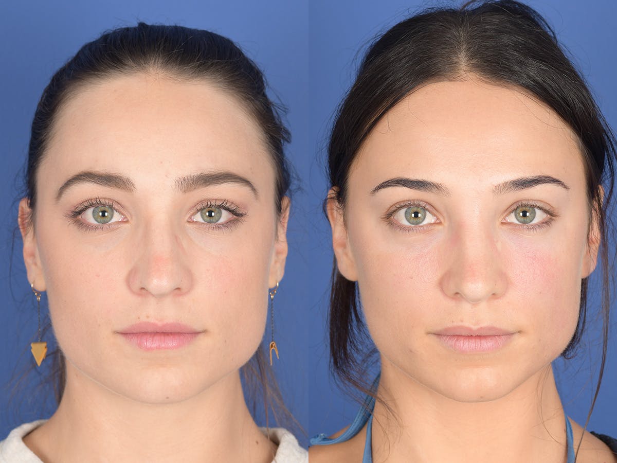 Rhinoplasty Before & After Gallery - Patient 414117 - Image 1