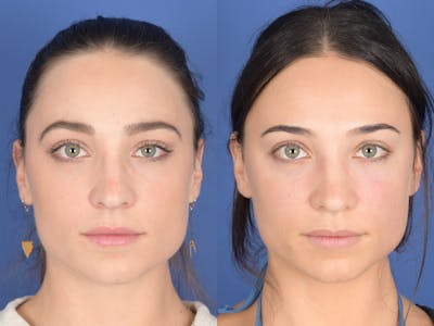 Rhinoplasty Before & After Gallery - Patient 414117 - Image 1
