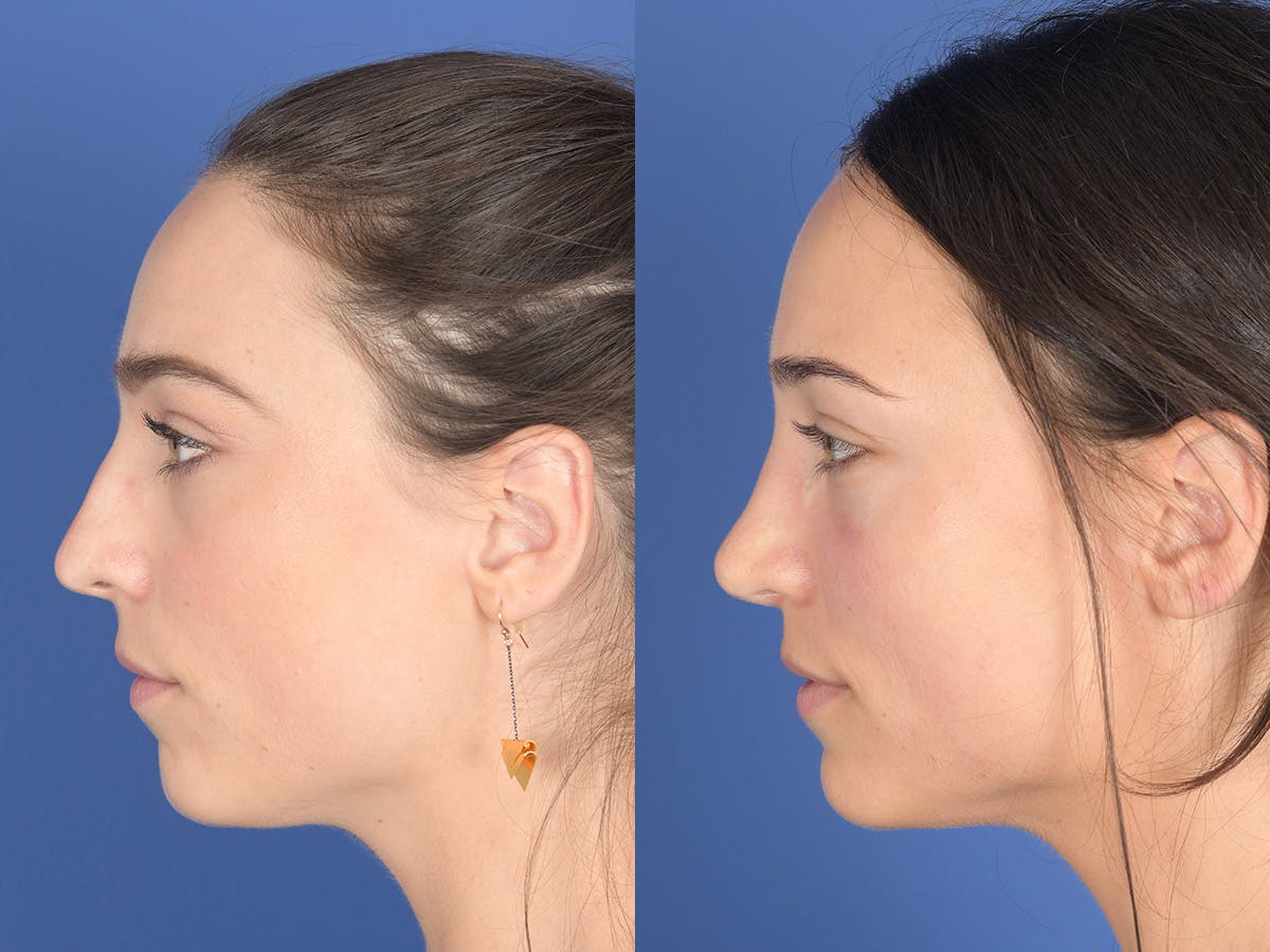 Rhinoplasty Before & After Gallery - Patient 414117 - Image 2