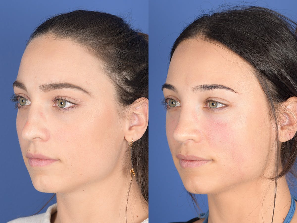 Rhinoplasty Before & After Gallery - Patient 414117 - Image 3