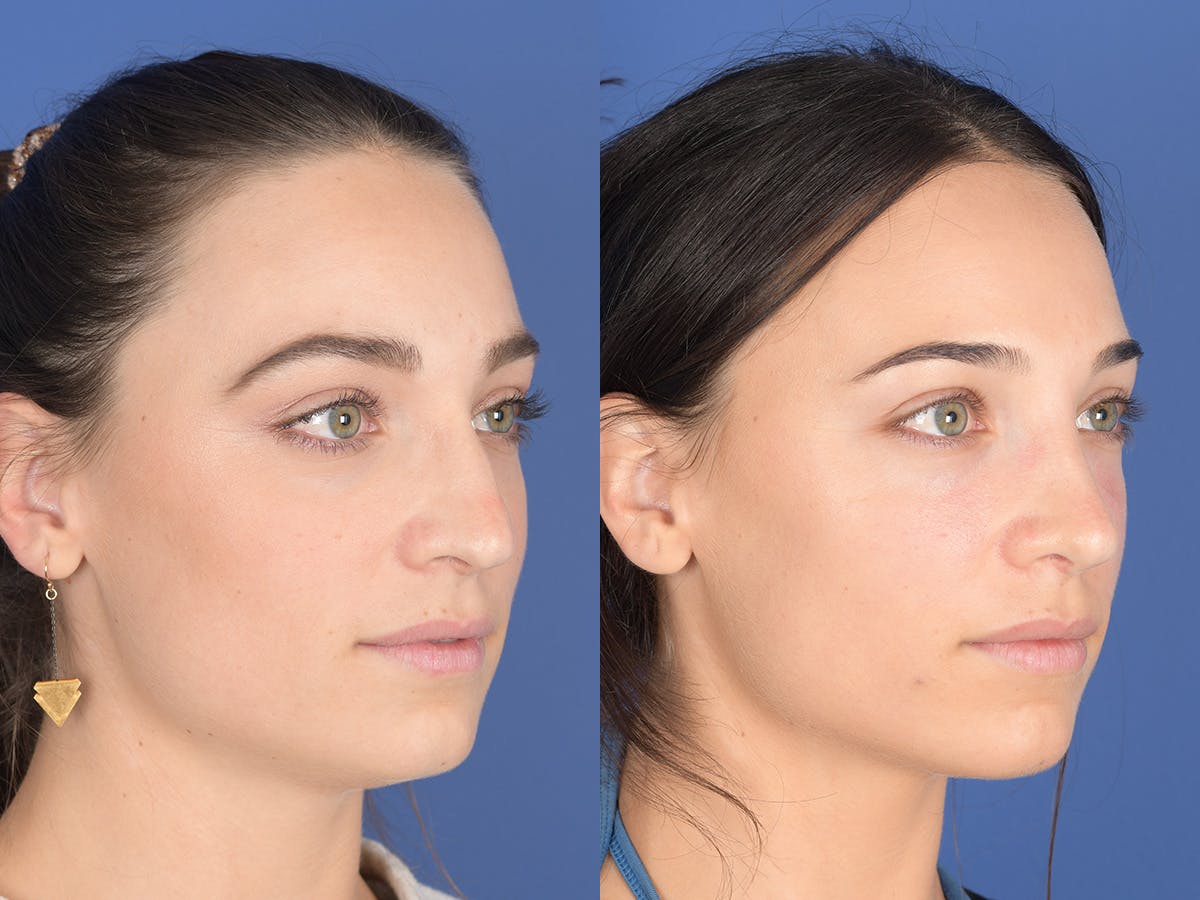 Rhinoplasty Before & After Gallery - Patient 414117 - Image 4