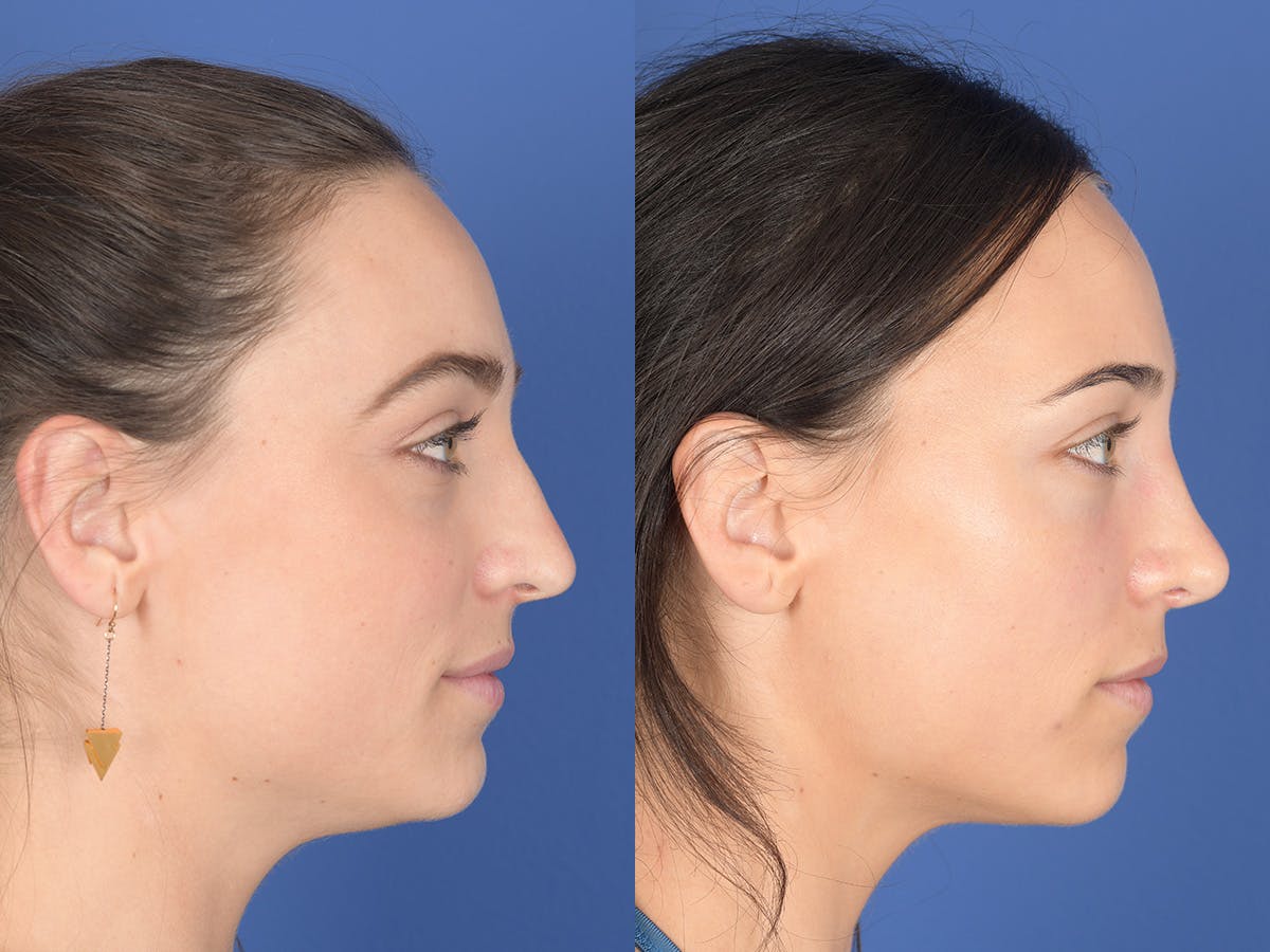 Rhinoplasty Before & After Gallery - Patient 414117 - Image 5
