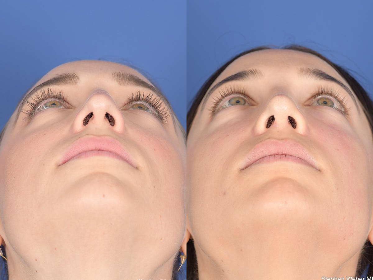 Rhinoplasty Before & After Gallery - Patient 414117 - Image 6