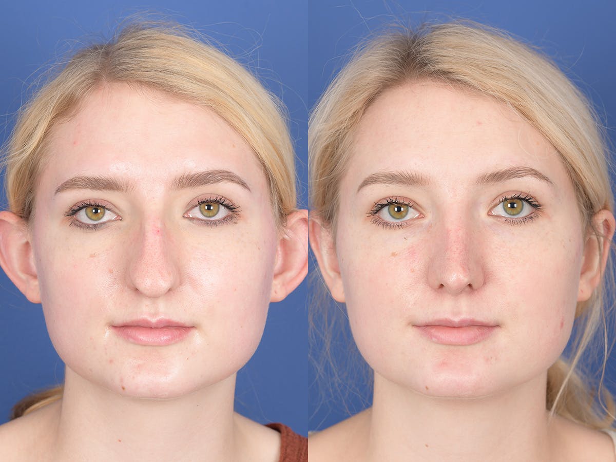 Rhinoplasty Before & After Gallery - Patient 255448 - Image 1